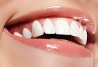 Teeth Whitening